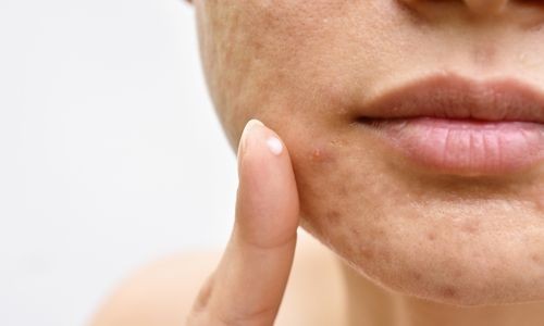 Soin pour peau acnéique : quelle routine de soin adopter ?