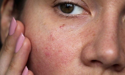 Rougeur sur le visage : Découvrez ses causes et ses solutions
