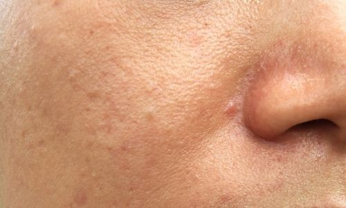 Peau granuleuse : causes, soins, prévention
